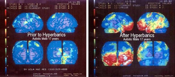 Comparison of brain scans showing changes in brain activity before and after hyperbaric treatment in a 17-year-old autistic male.