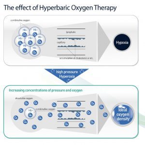 36-Inch Hard Shell Hyperbaric Oxygen Chamber 1.6 ATA